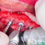 Curso de Implantologia Oral Galeria de imágenes